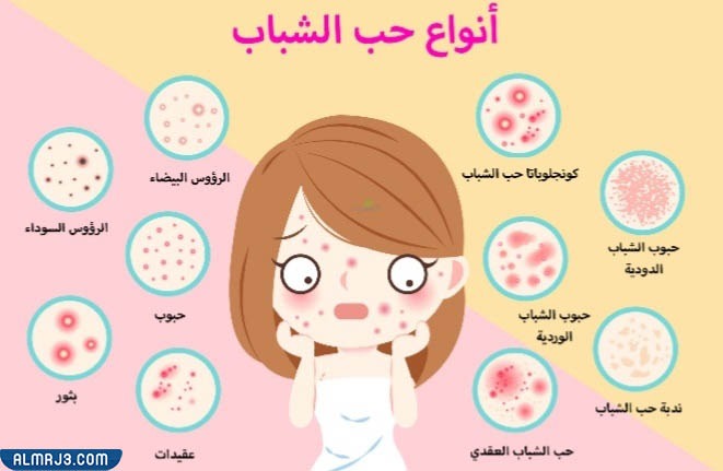 ما هي أنواع حب الشباب