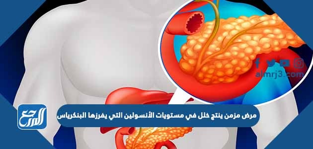 مرض مزمن ينتج خلل في مستويات الأنسولين التي يفرزها البنكرياس