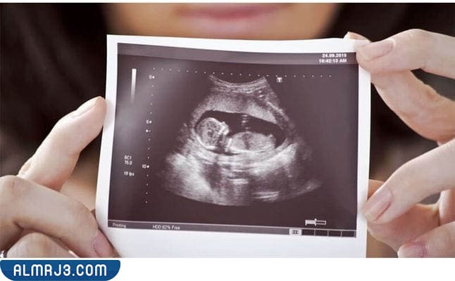 معرفة نوع الجنين بالسونار