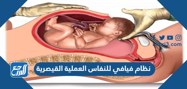نظام فيافي للنفاس العملية القيصرية
