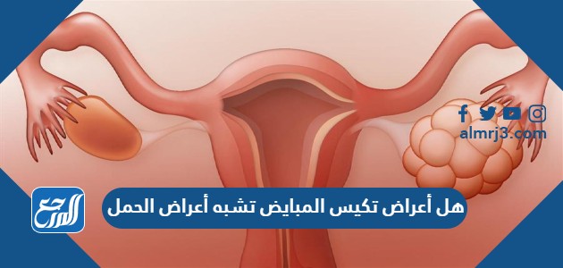 هل أعراض تكيس المبايض تشبه أعراض الحمل