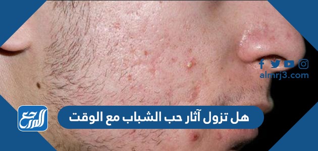 هل تزول آثار حب الشباب مع الوقت