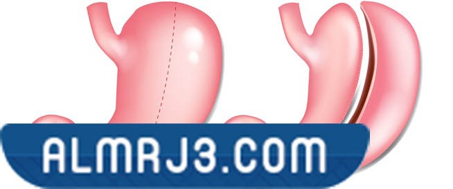 أولاً: عملية قص المعدة