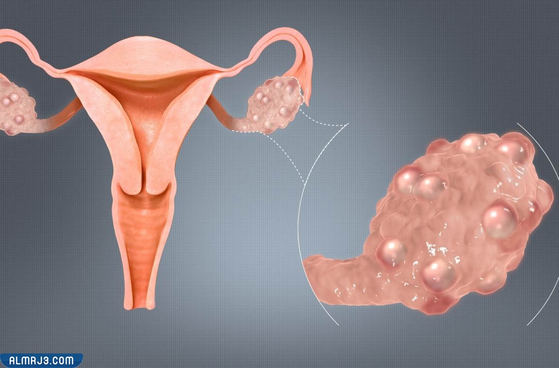 أسباب كيسات المبايض