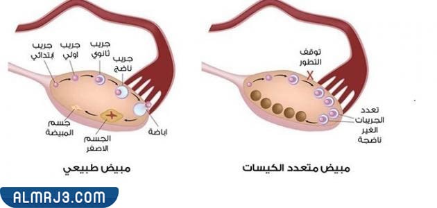 أسباب الإصابة بتكيس المبايض