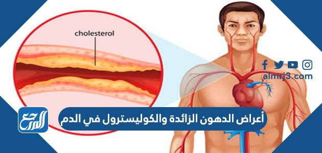 أعراض الدهون الزائدة والكوليسترول في الدم