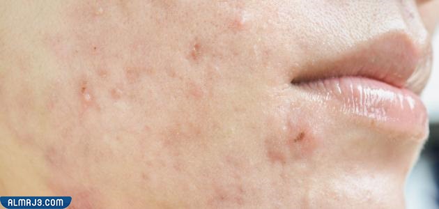 أعراض ظهور الحبوب حول الفم والذقن