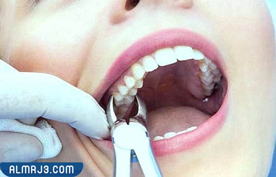 إرشادات بعد خلع ضرس العقل