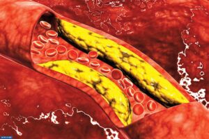 اعراض الكولسترول النفسية