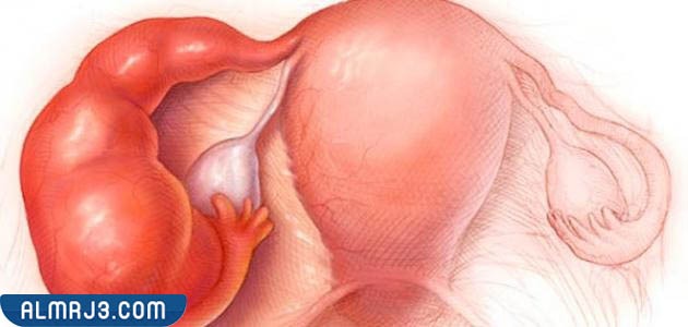 الكيس المائي على المبيض