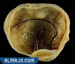 الكيسات البشرانية