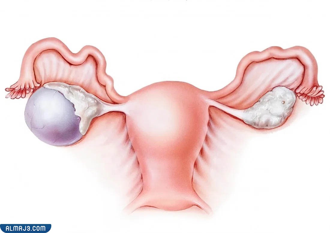 انفجار الكيس المائي