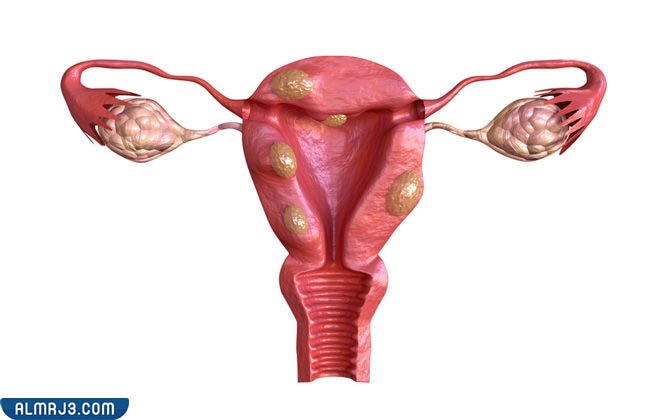 بطانة الرحم المهاجرة
