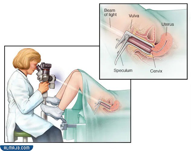 تجاربكم مع كي قرحة الرحم