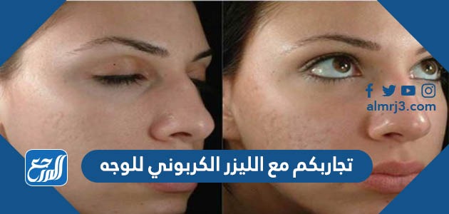 تجاربكم مع الليزر الكربوني للوجه