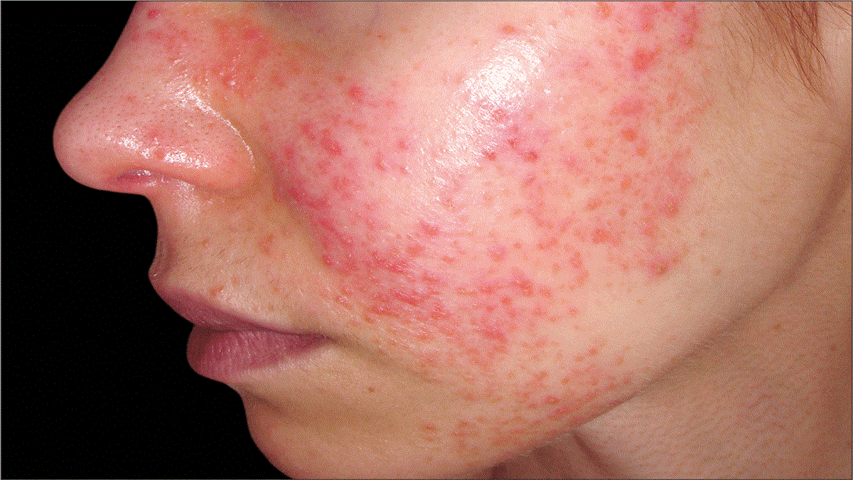 تجربتي مع الذئبة الحمراء