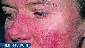 ما هو مرض الذئبة الحمراء ؟