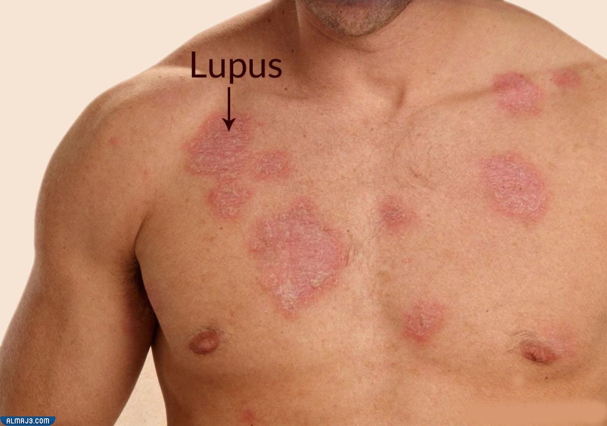 بعض الإرشادات للمصابين بالمرض وكيفية الوقاية منه