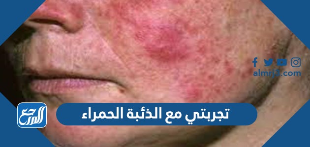 تجربتي مع الذئبة الحمراء