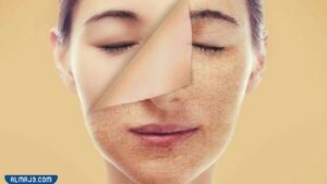 تجربتي مع الليزر الكربوني للبشرة الحساسة