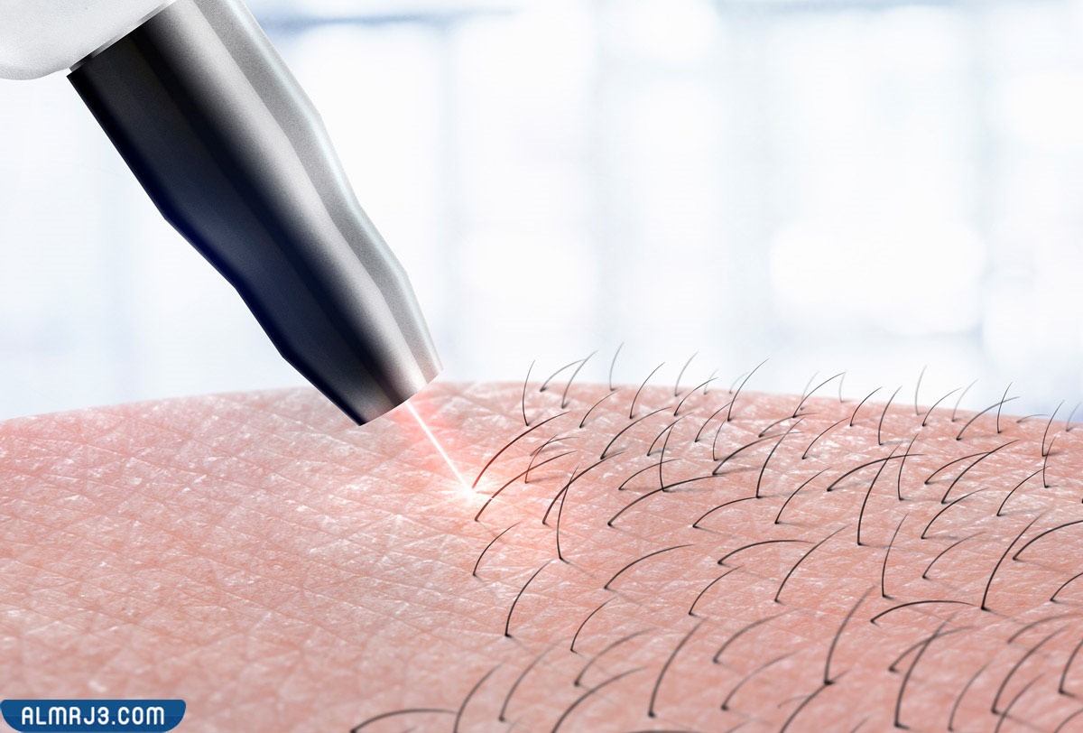كم جلسة ليزر يحتاج الجسم لإزالة الشعر في العيادات