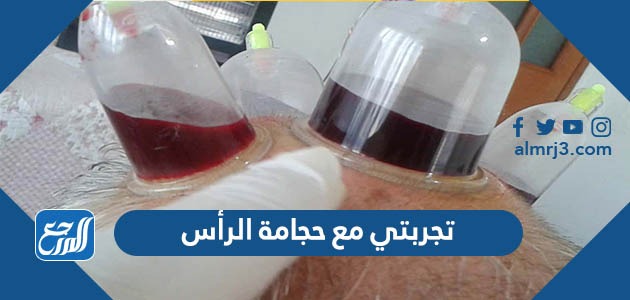 تجربتي مع حجامة الرأس