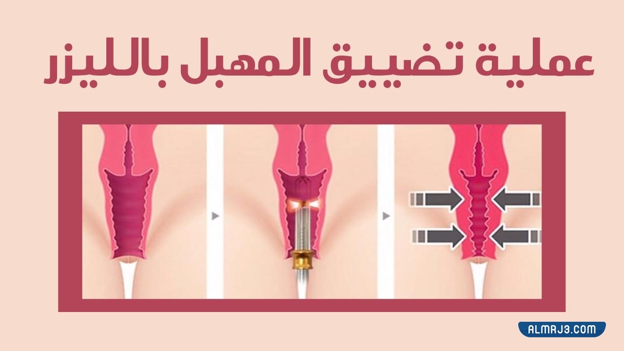 تجربتي مع عملية تضييق المهبل بالليزر