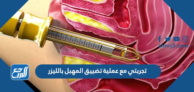 تجربتي مع عملية تضييق المهبل بالليزر