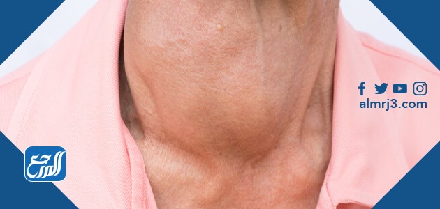 تضخم الغدة الدرقية