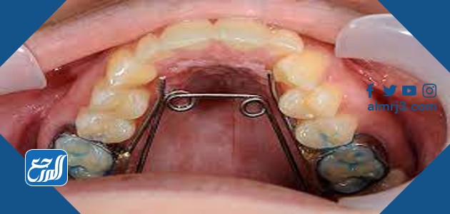 تقويم الاسنان