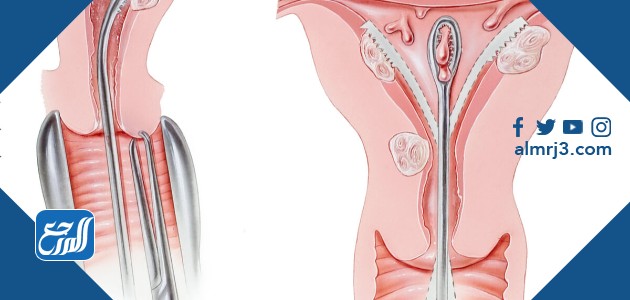 تنظيف الرحم