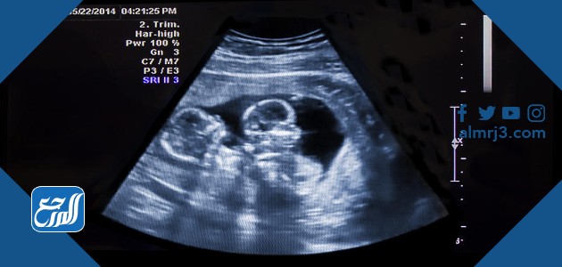 جهاز السونار