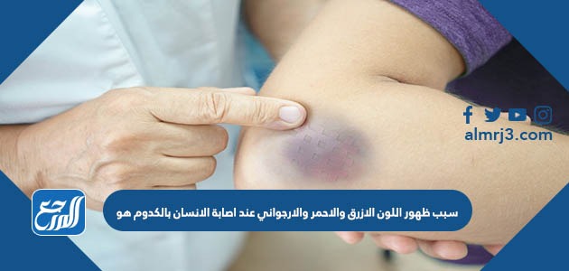 سبب ظهور اللون الازرق والاحمر والارجواني عند اصابة الانسان بالكدوم هو