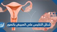 شكل التكيس على المبيض بالصور