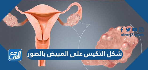شكل التكيس على المبيض بالصور