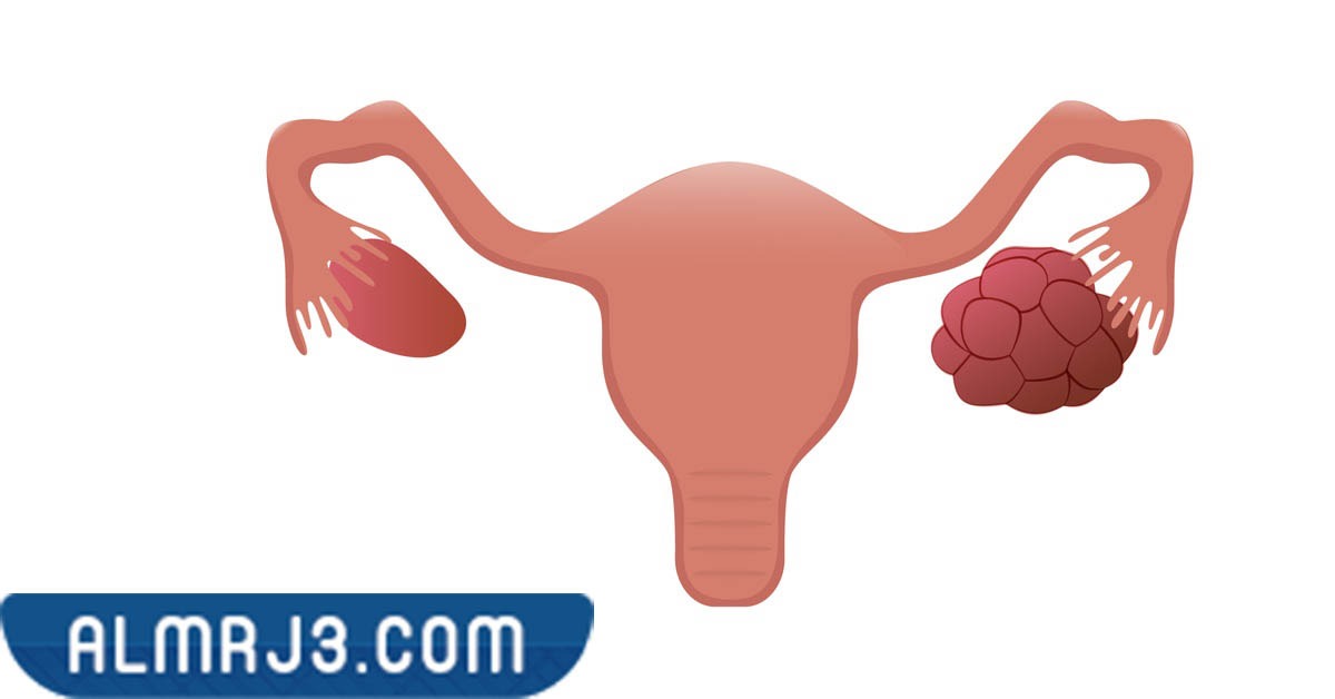 طرق تشخيص تكيس المبايض