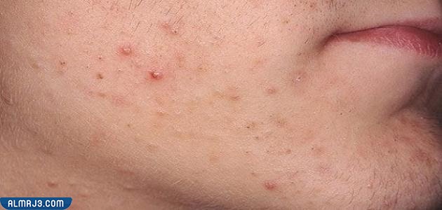 طرق علاج حبوب الفم والذقن