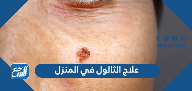 علاج الثالول في المنزل