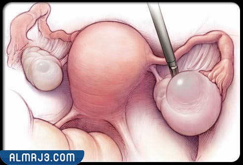 كيسات المبيض السرطانية