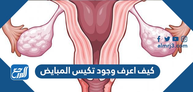 كيف اعرف وجود تكيس المبايض