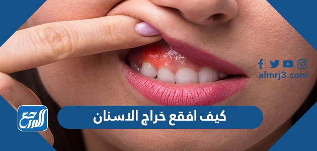 كيف افقع خراج الاسنان