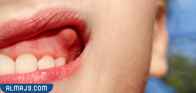 كيف افقع خراج الاسنان