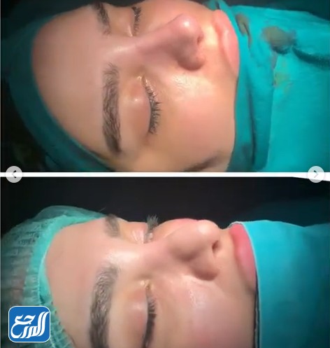 ليلى الكندري قبل وبعد