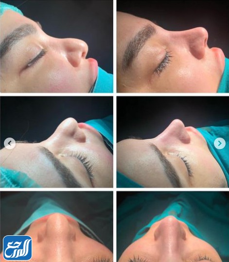 ليلى الكندري قبل وبعد