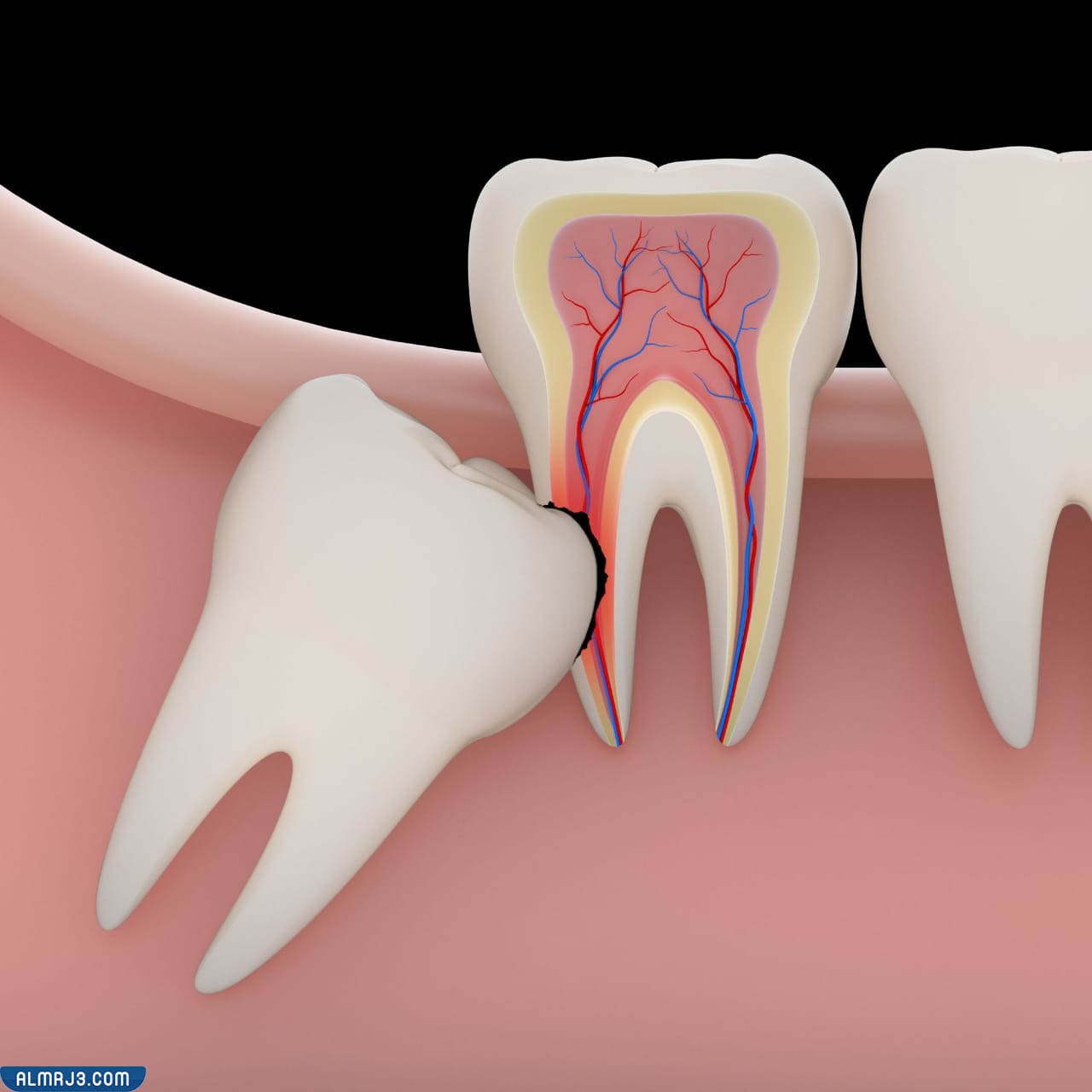 ما هو ضرس العقل