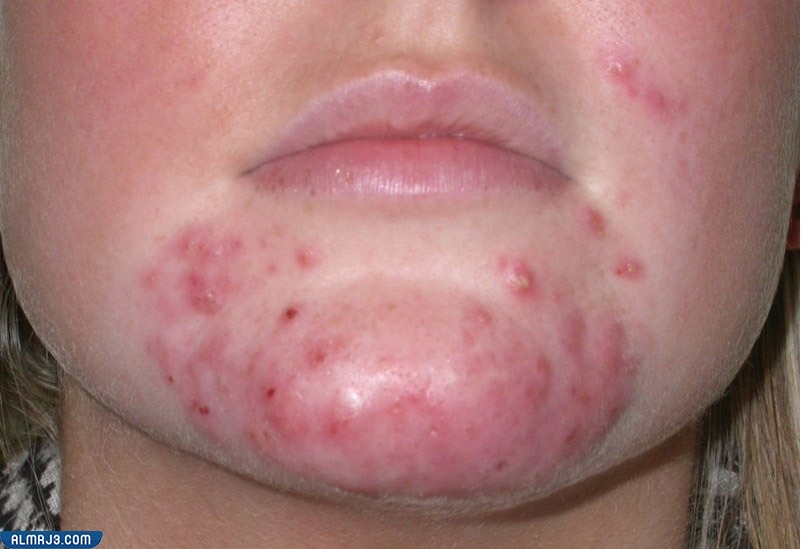 محفزات ظهور الحبوب حول الفم والذقن