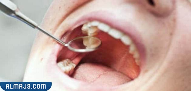 هل عملية خلع ضرس العقل مؤلمة 