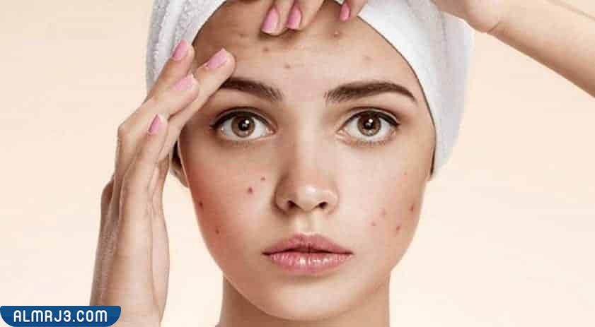 وصفات إزالة الحبوب من الوجه الدهني