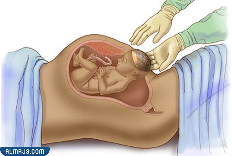 مفهوم الولادة القيصرية