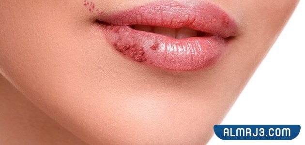 أسباب الإصابة بحبوب الشفايف